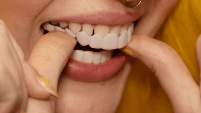 Snap on Smile Veneers